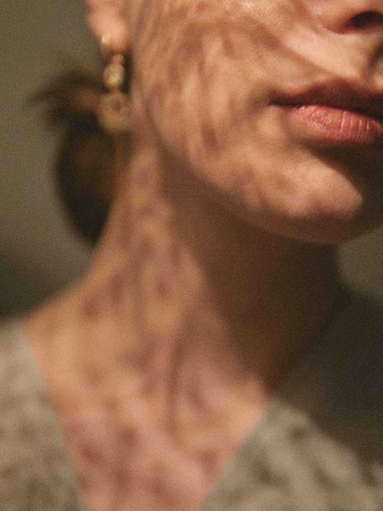 Pigmentflekker i ansikt og hals hos kvinne